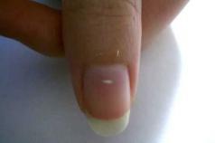 Почему на ногтях появляются белые или черные пятна